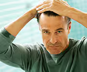 DHT and Baldness